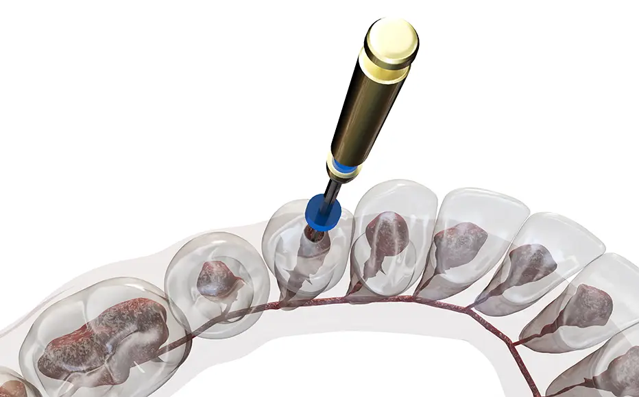 Root canal treatment