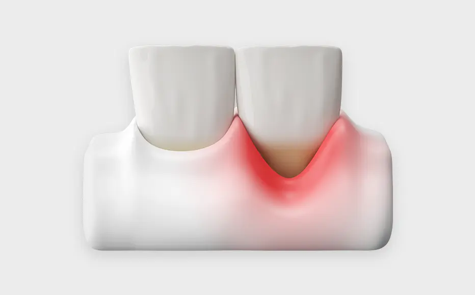 Periodontal disease treatment