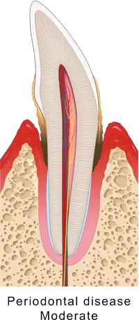 歯周炎（中度）